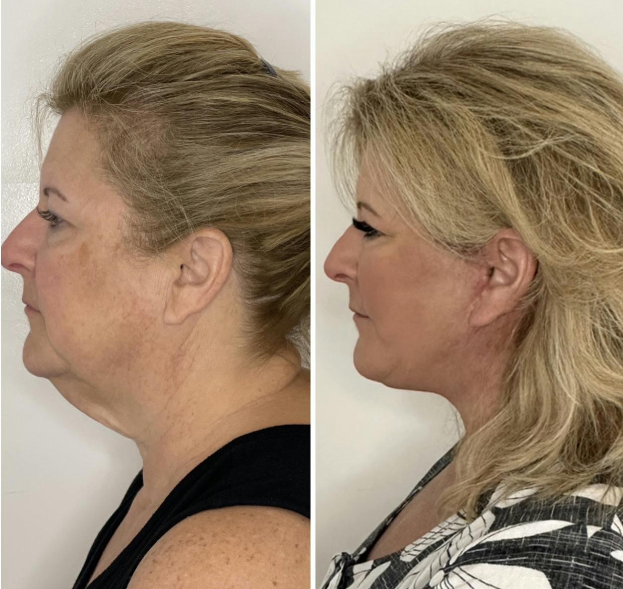 Deep Plane Facelift Before & After Gallery - Patient 138997 - Image 5