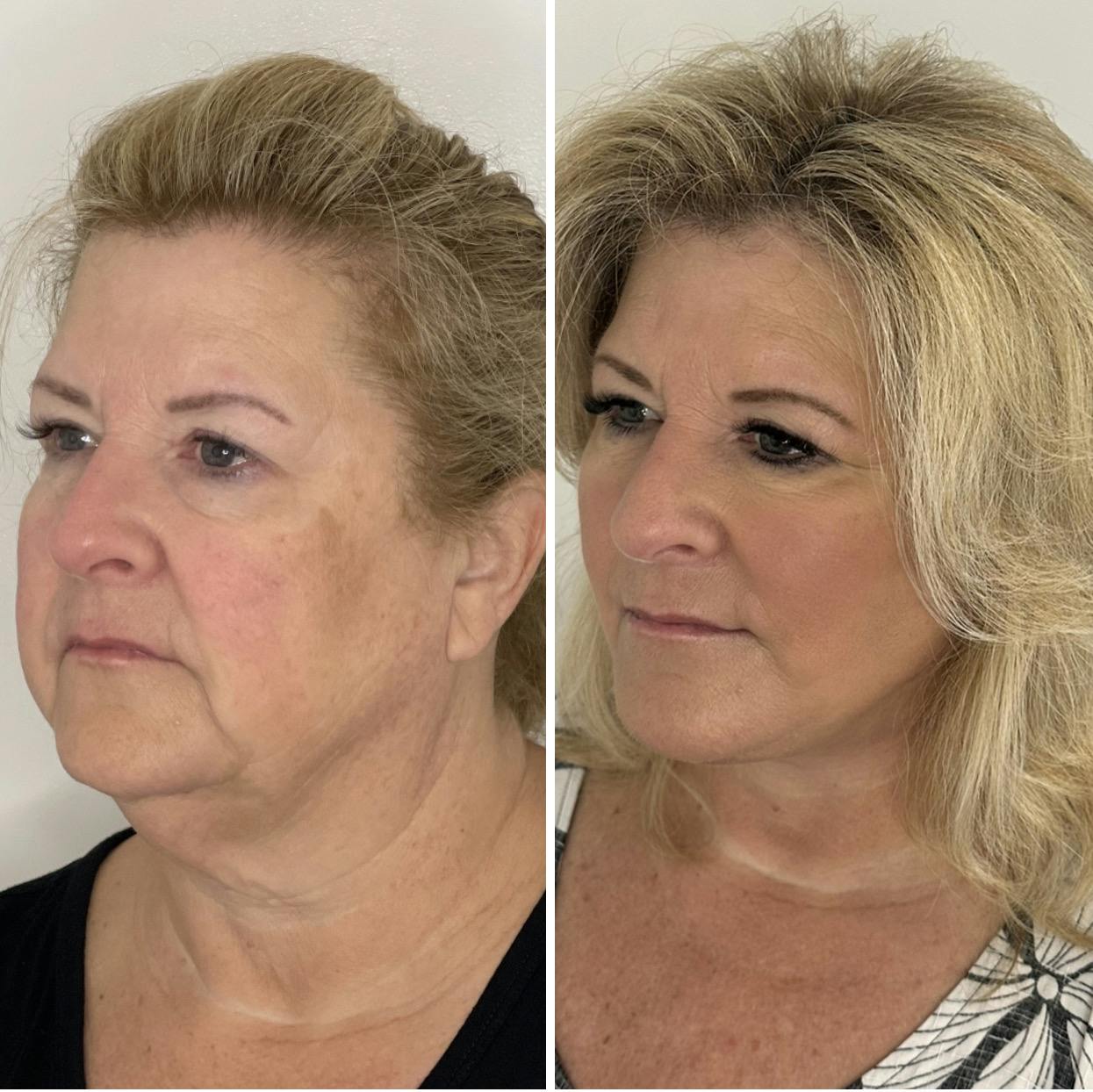 Deep Plane Facelift Before & After Gallery - Patient 138997 - Image 4