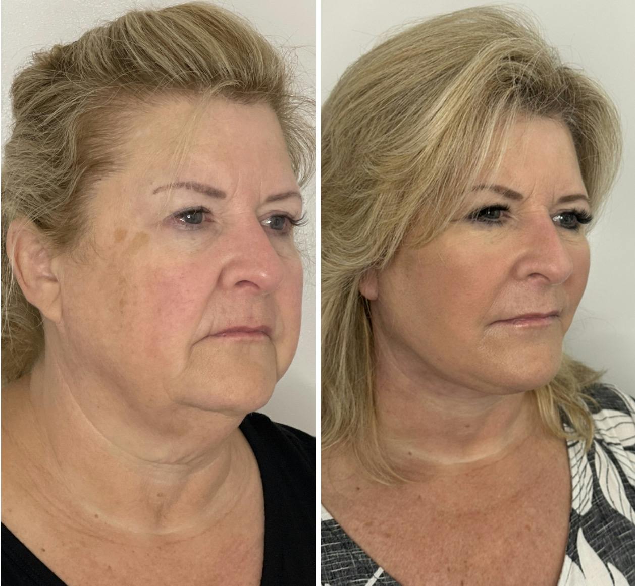 Deep Plane Facelift Before & After Gallery - Patient 138997 - Image 2