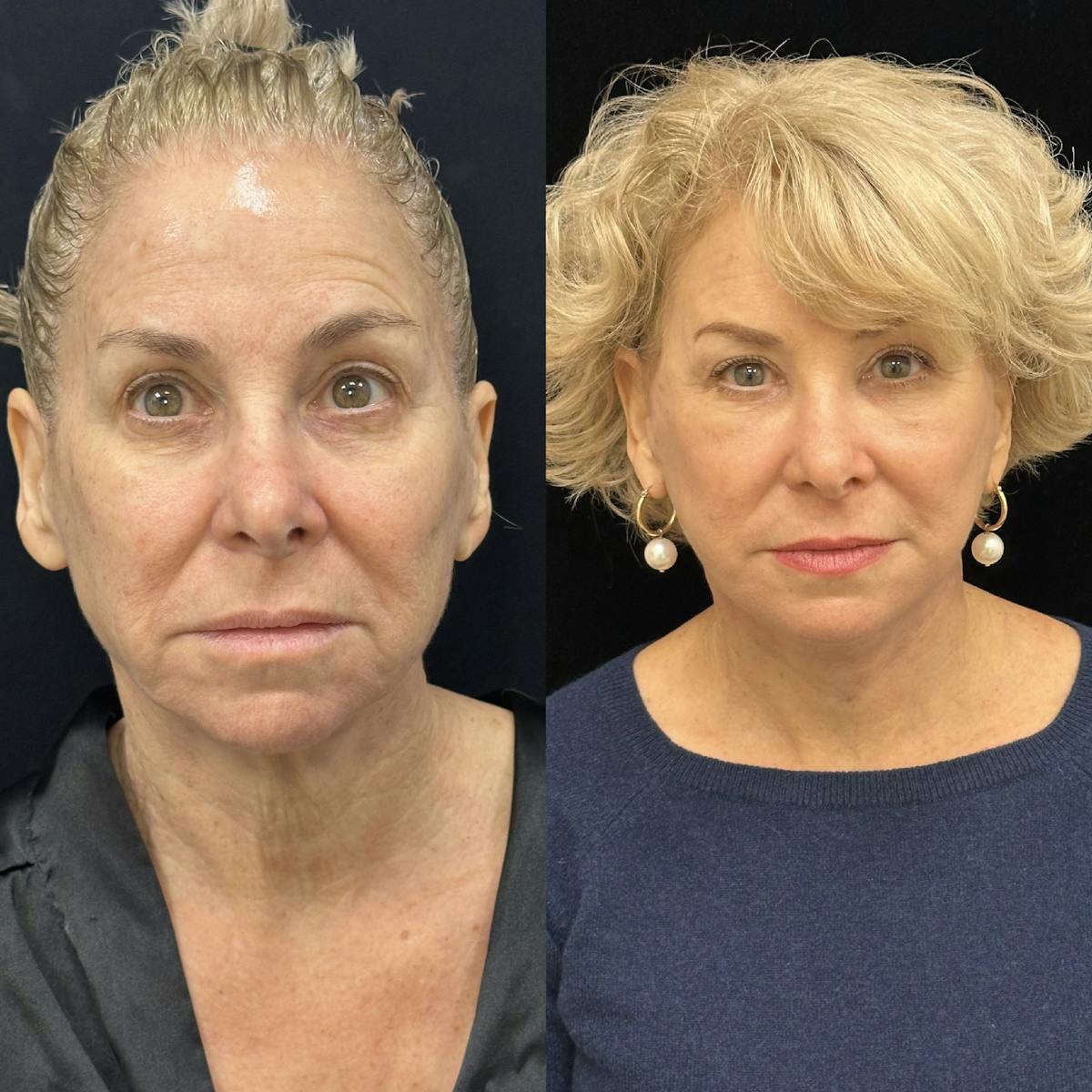Deep Plane Facelift Before & After Gallery - Patient 214375 - Image 1