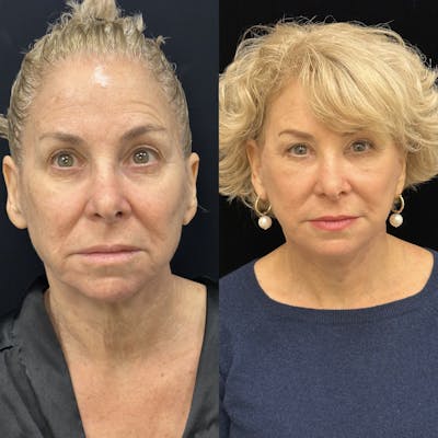 Deep Plane Facelift Before & After Gallery - Patient 214375 - Image 1