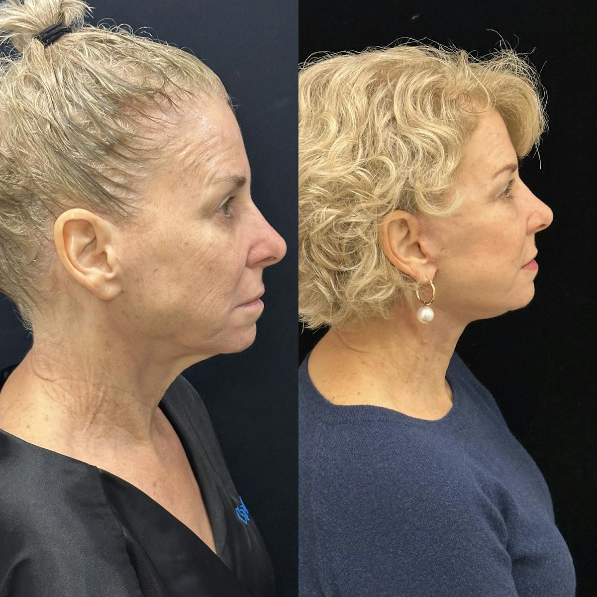 Deep Plane Facelift Before & After Gallery - Patient 214375 - Image 3