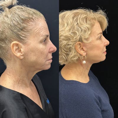 Deep Plane Facelift Before & After Gallery - Patient 214375 - Image 3