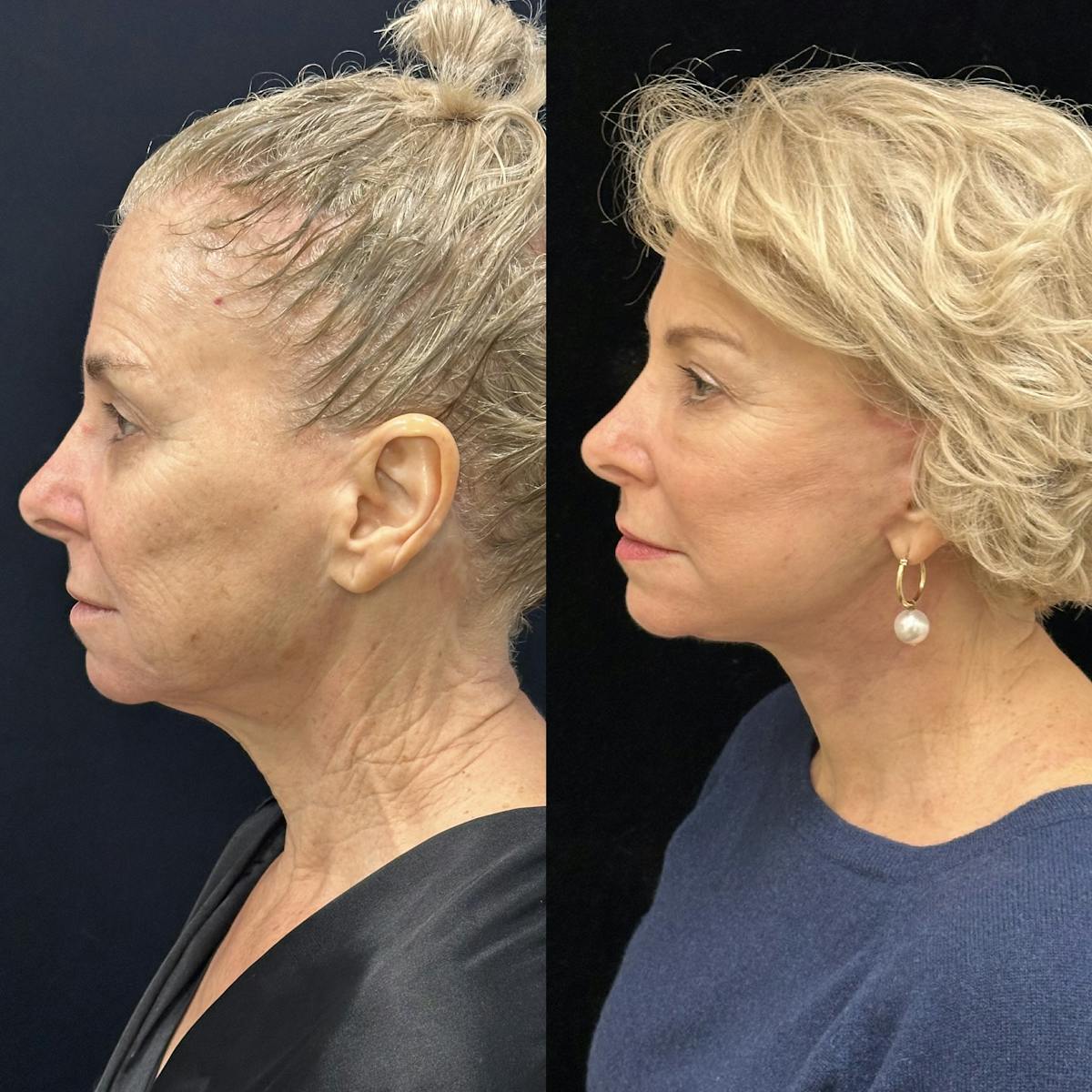 Deep Plane Facelift Before & After Gallery - Patient 214375 - Image 5