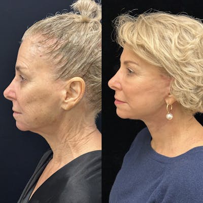 Deep Plane Facelift Before & After Gallery - Patient 214375 - Image 5
