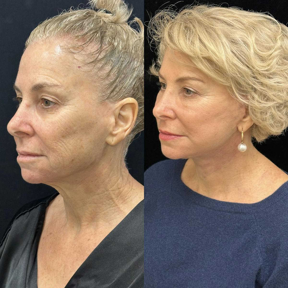 Deep Plane Facelift Before & After Gallery - Patient 214375 - Image 4