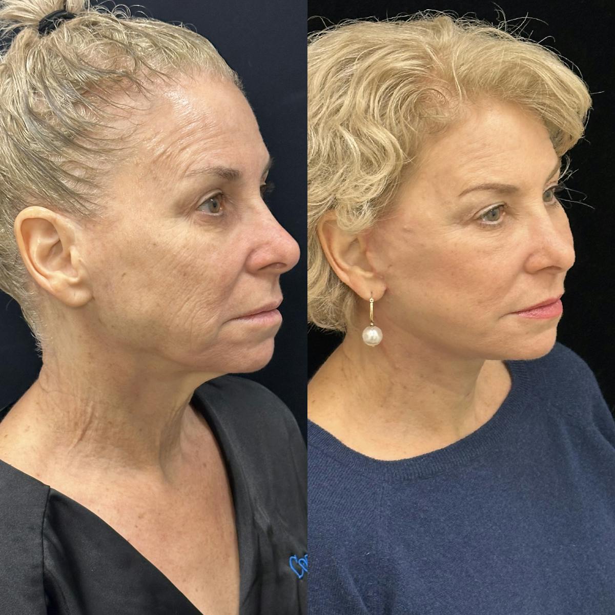 Deep Plane Facelift Before & After Gallery - Patient 214375 - Image 2