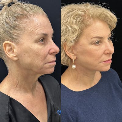 Deep Plane Facelift Before & After Gallery - Patient 214375 - Image 2