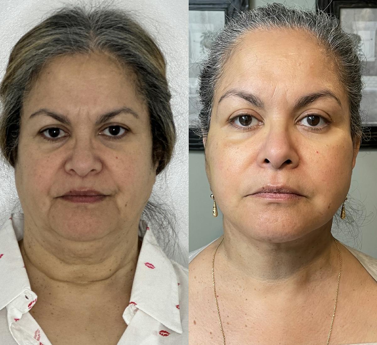 Deep Plane Facelift Before & After Gallery - Patient 412459 - Image 1