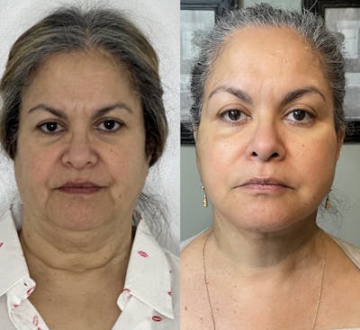 Deep Plane Facelift Before & After Gallery - Patient 412459 - Image 1