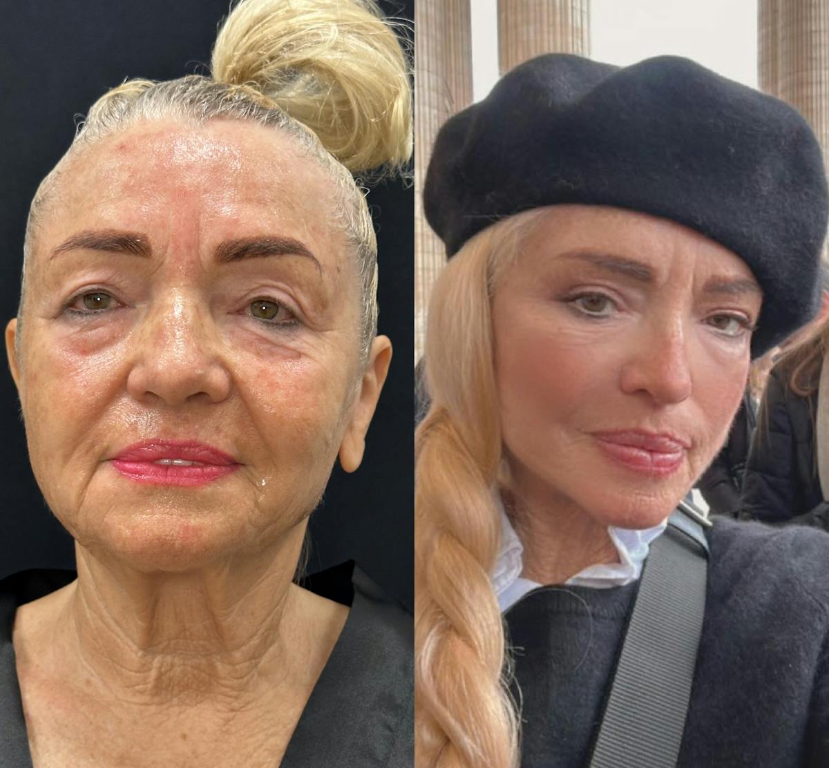 Deep Plane Facelift Before & After Gallery - Patient 248748 - Image 1