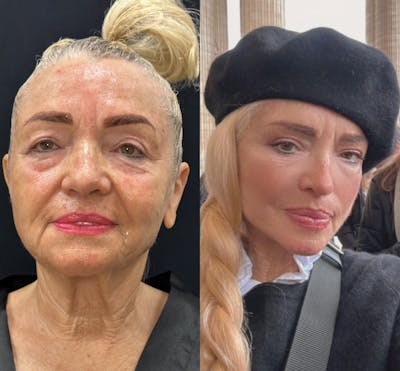 Deep Plane Facelift Before & After Gallery - Patient 248748 - Image 1