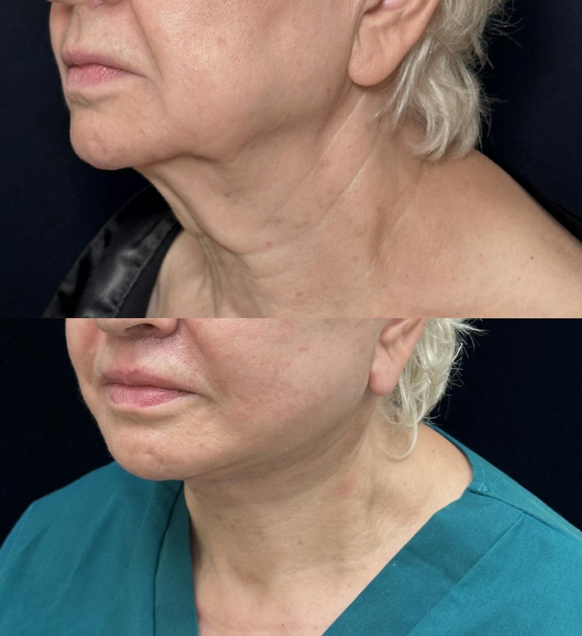 Deep Plane Facelift Before & After Gallery - Patient 696768 - Image 2