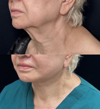 Deep Plane Facelift Before & After Gallery - Patient 696768 - Image 2