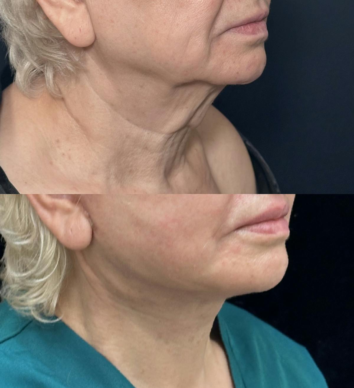 Deep Plane Facelift Before & After Gallery - Patient 696768 - Image 1