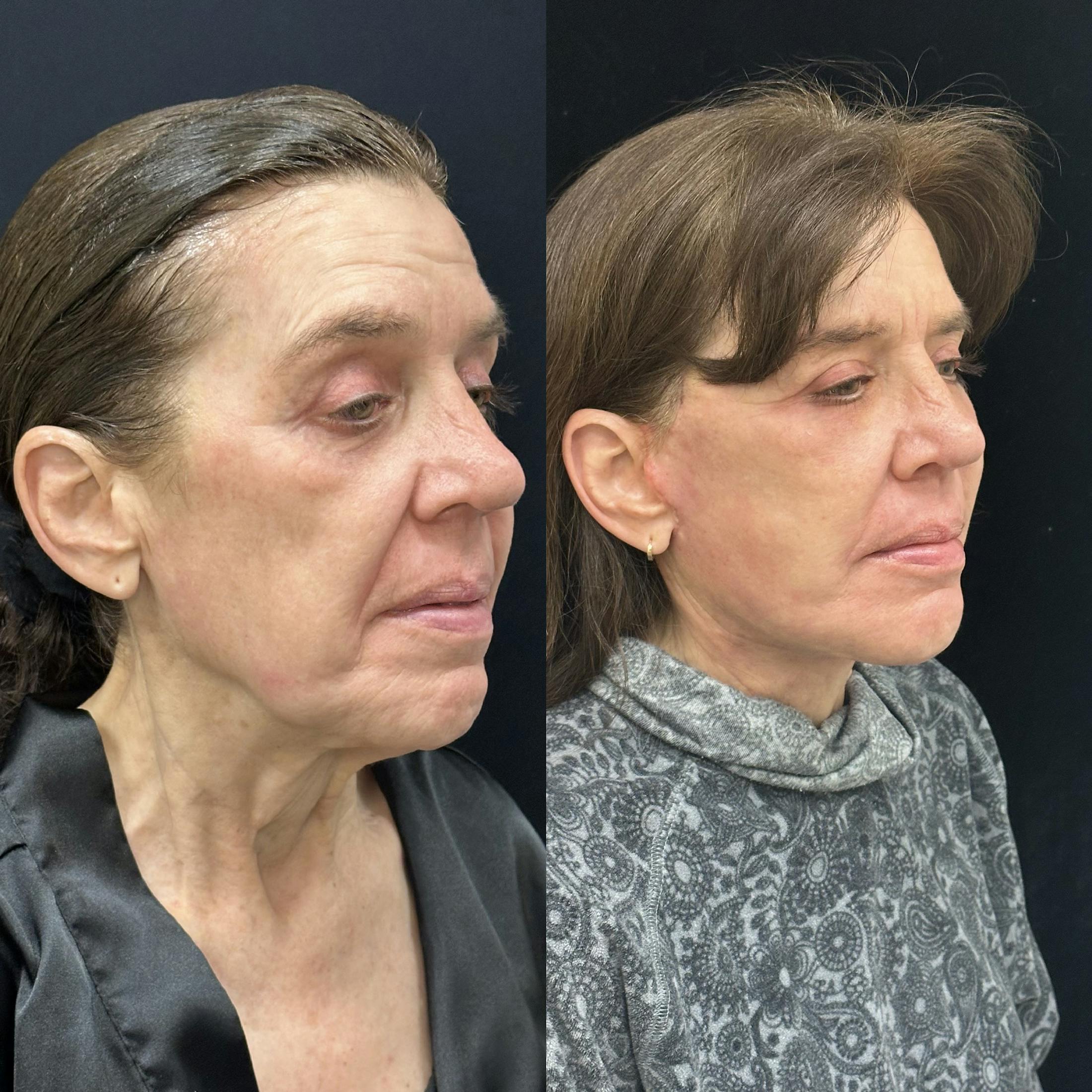 Deep Plane Facelift Before & After Gallery - Patient 198157 - Image 2