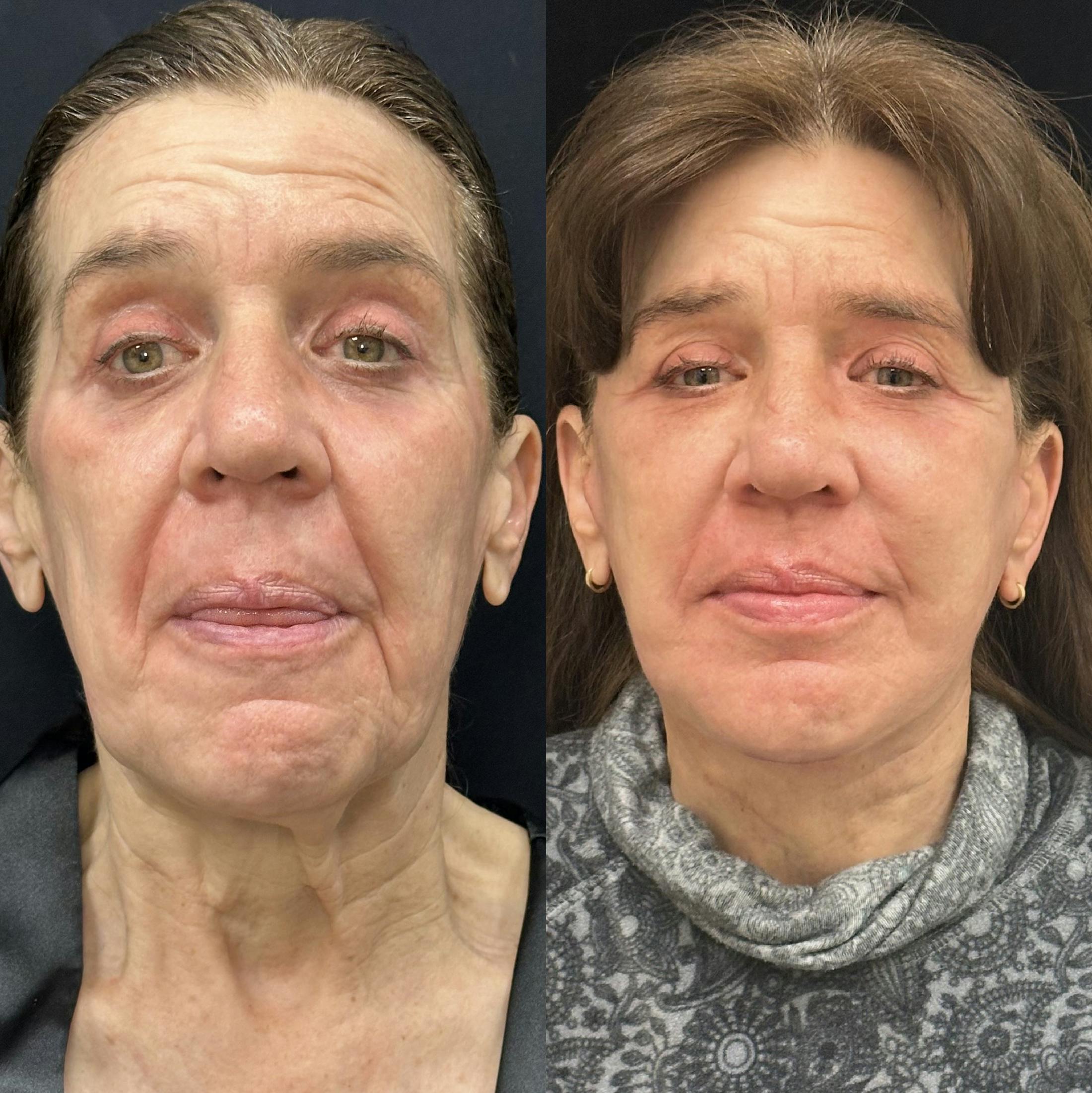 Deep Plane Facelift Before & After Gallery - Patient 198157 - Image 1