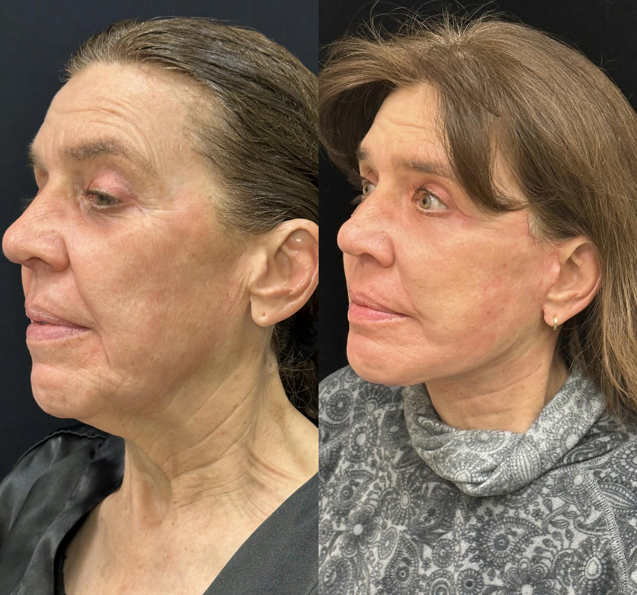 Deep Plane Facelift Before & After Gallery - Patient 198157 - Image 4