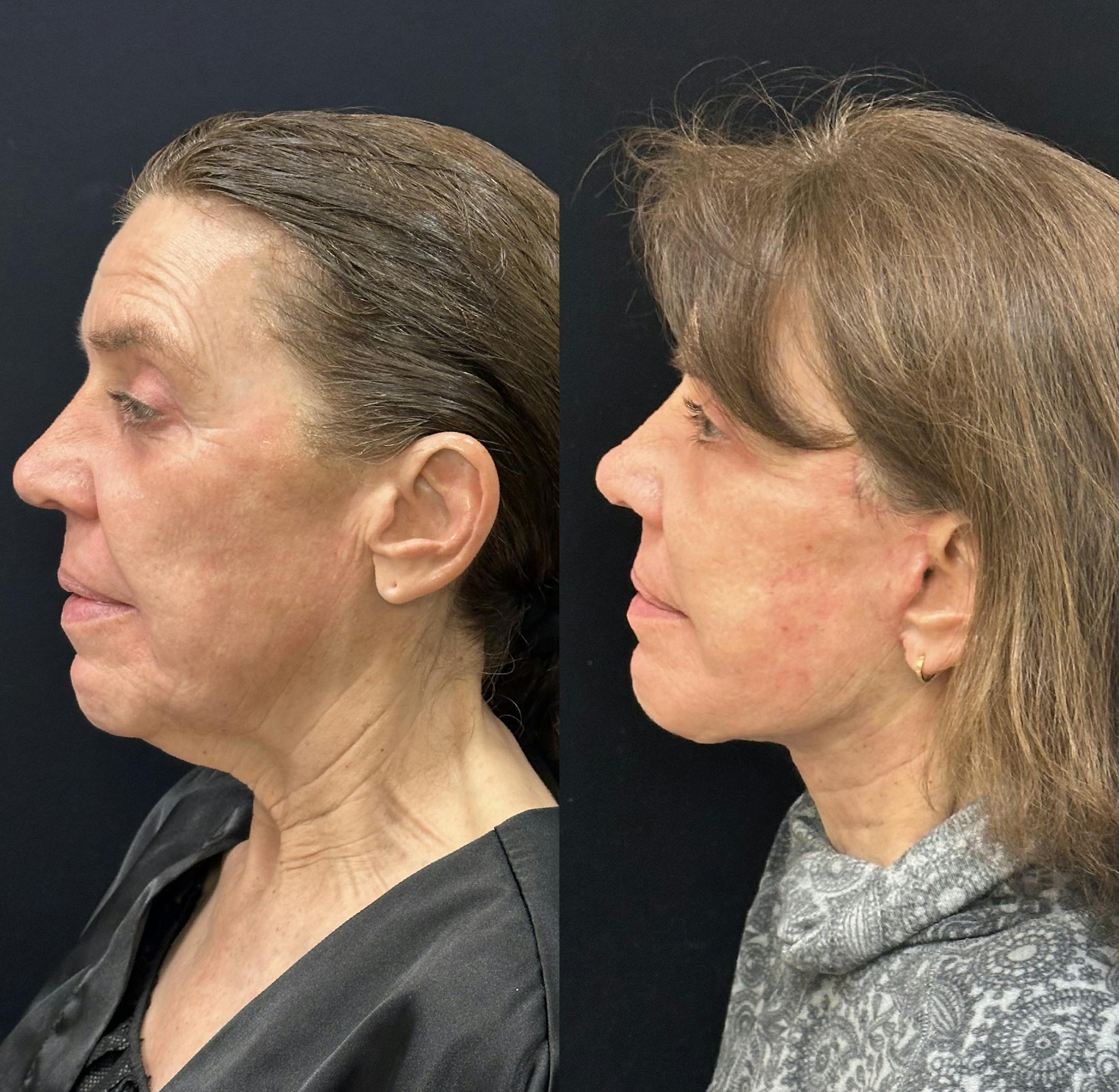 Deep Plane Facelift Before & After Gallery - Patient 198157 - Image 5