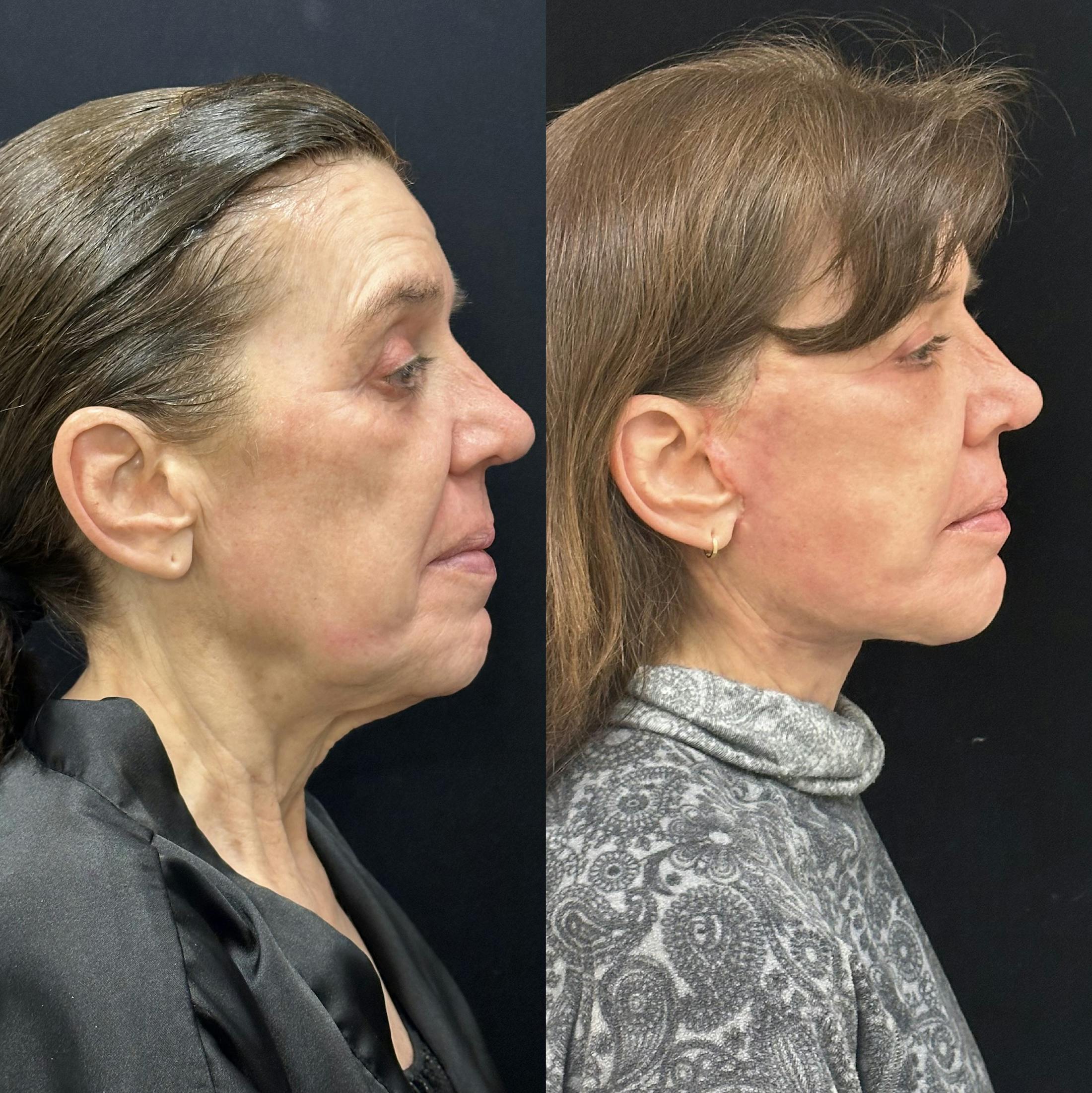 Deep Plane Facelift Before & After Gallery - Patient 198157 - Image 3