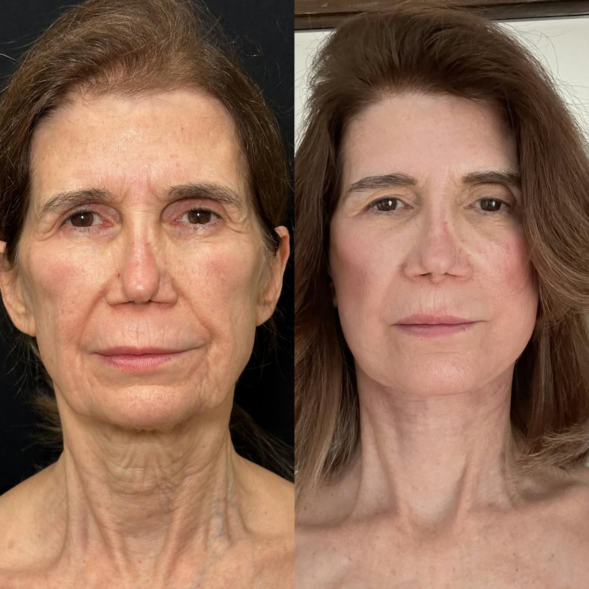 Deep Plane Facelift Before & After Gallery - Patient 163592 - Image 1