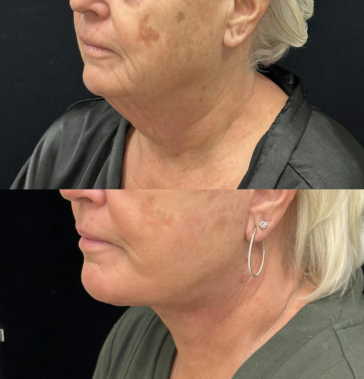 Deep Plane Facelift Before & After Gallery - Patient 261437 - Image 4
