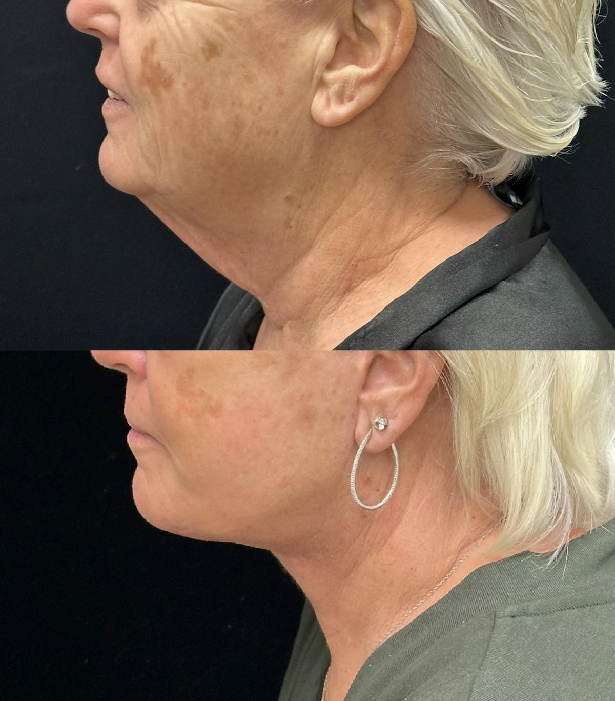 Deep Plane Facelift Before & After Gallery - Patient 261437 - Image 5