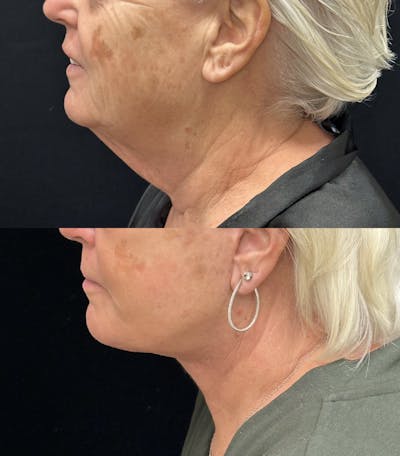 Deep Plane Facelift Before & After Gallery - Patient 261437 - Image 5