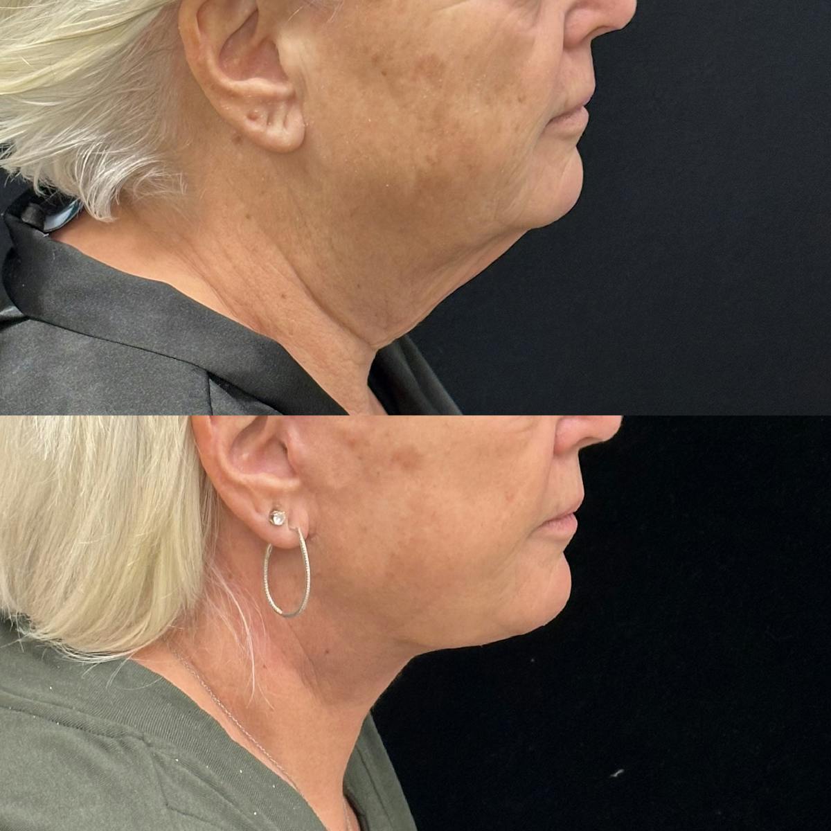 Deep Plane Facelift Before & After Gallery - Patient 261437 - Image 3