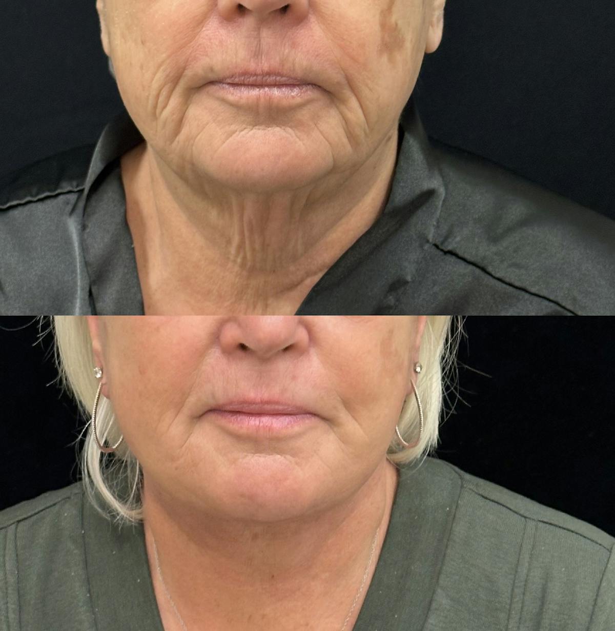 Deep Plane Facelift Before & After Gallery - Patient 261437 - Image 1