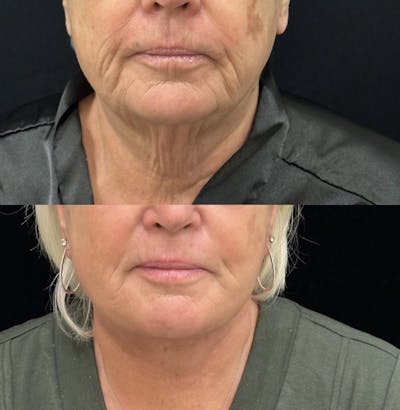 Deep Plane Facelift Before & After Gallery - Patient 261437 - Image 1