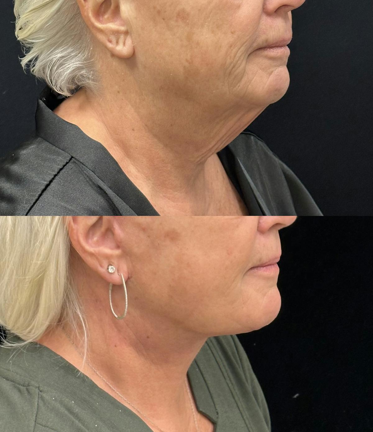 Deep Plane Facelift Before & After Gallery - Patient 261437 - Image 2