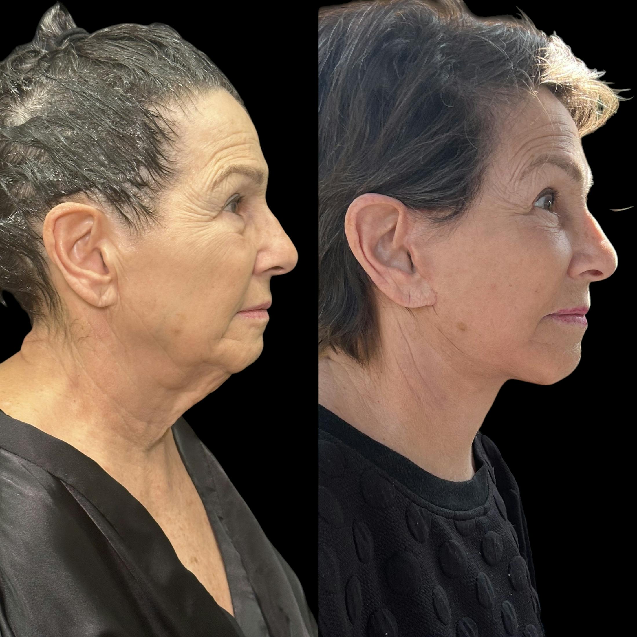 Deep Plane Facelift Before & After Gallery - Patient 239679 - Image 2
