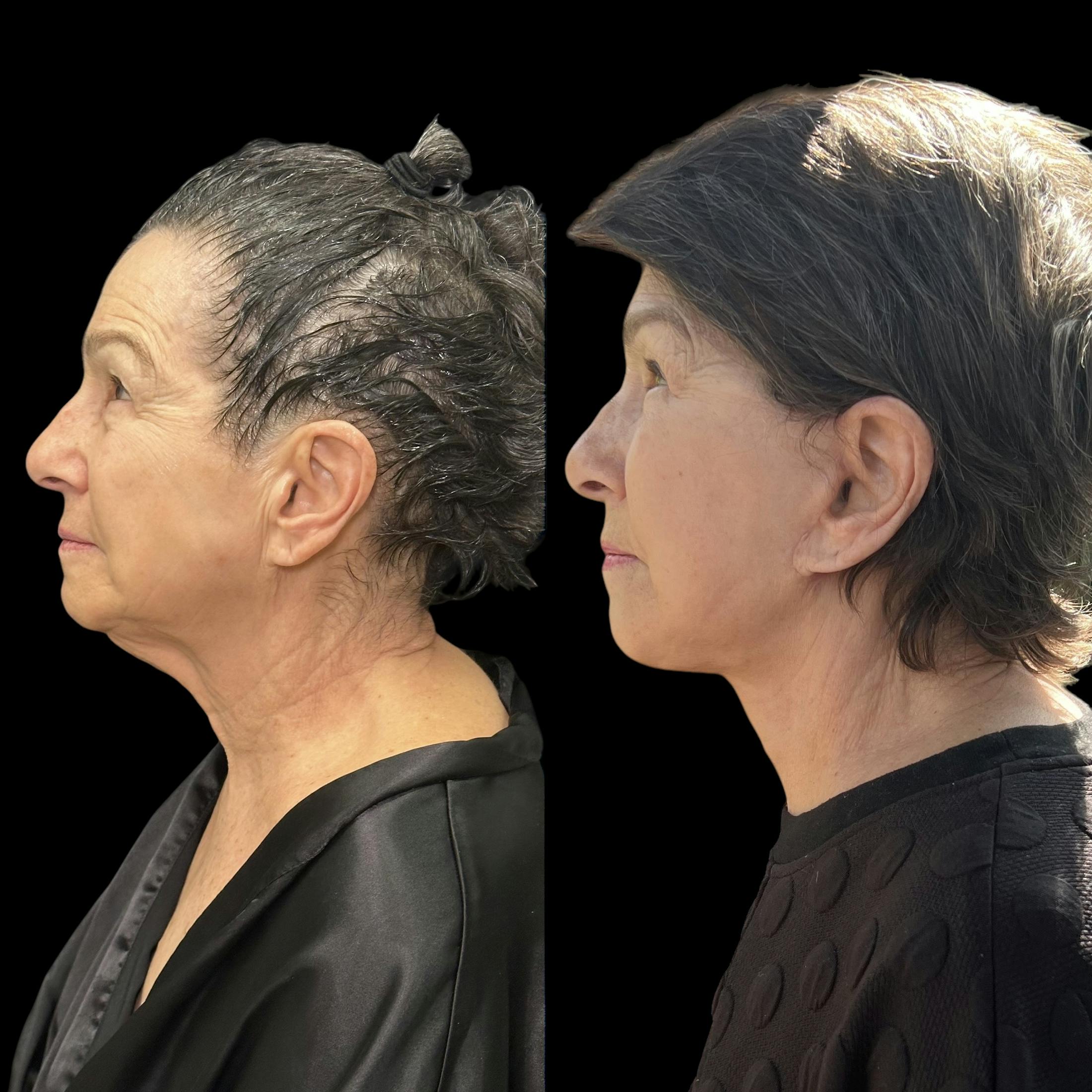 Deep Plane Facelift Before & After Gallery - Patient 239679 - Image 1