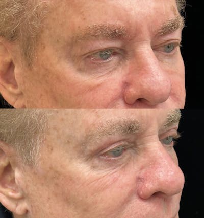 Upper Blepharoplasty Before & After Gallery - Patient 190029 - Image 2