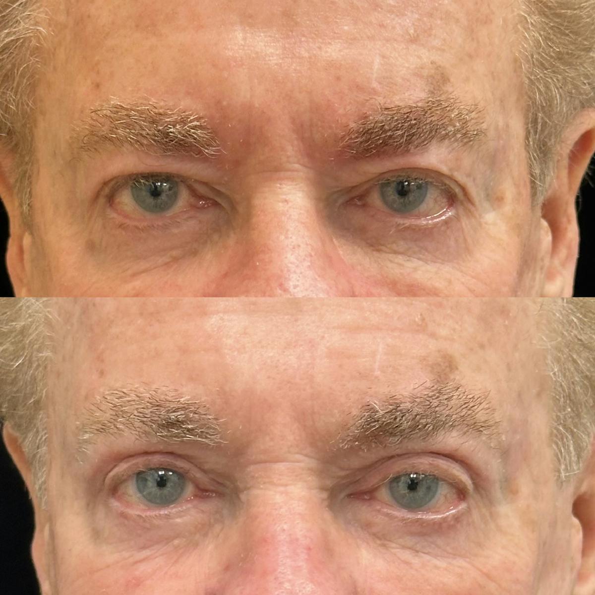  Upper Blepharoplasty Before & After Gallery - Patient 190029 - Image 1