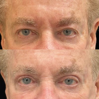 Upper Blepharoplasty Before & After Gallery - Patient 190029 - Image 1