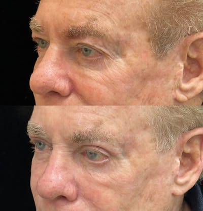 Upper Blepharoplasty Before & After Gallery - Patient 190029 - Image 3