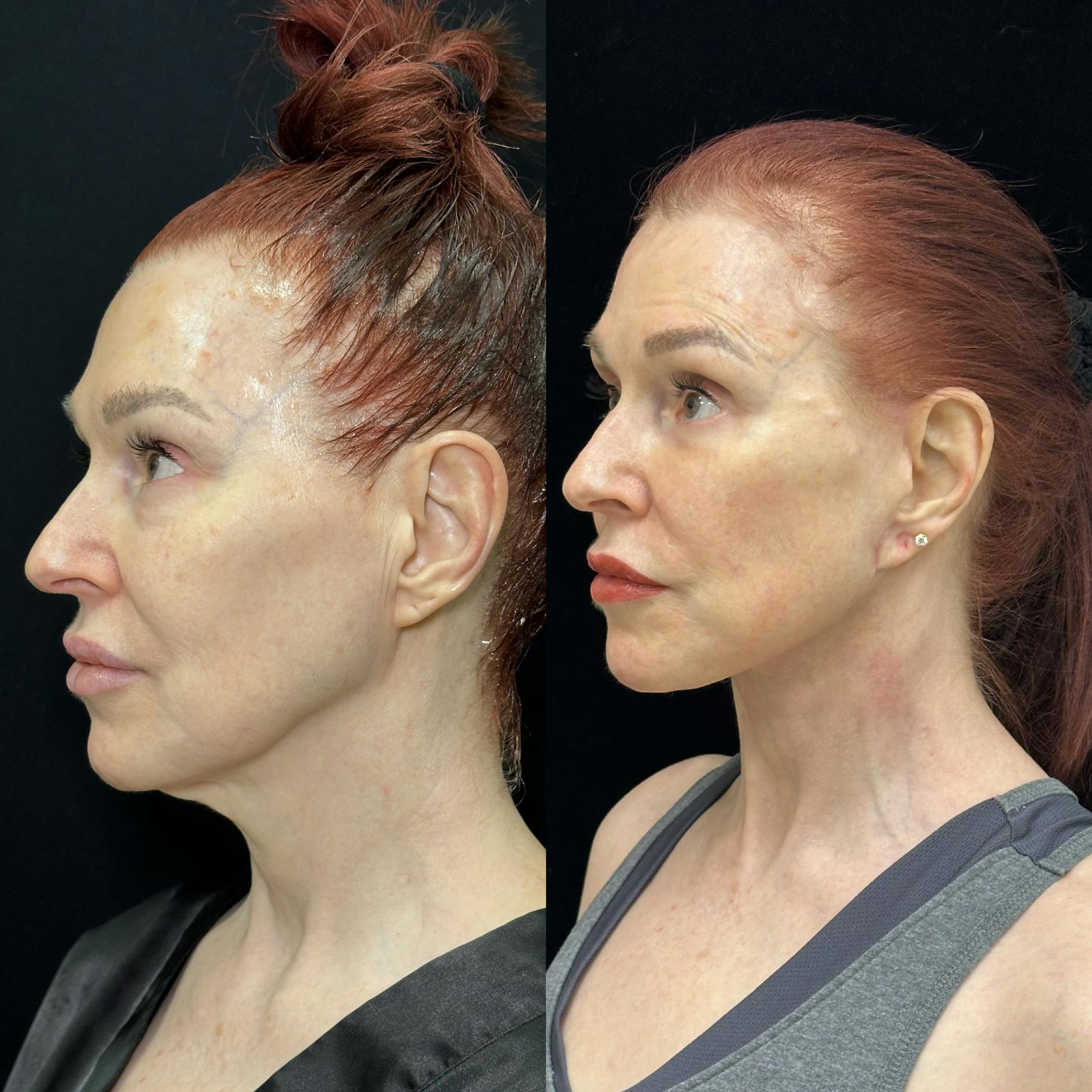 Deep Plane Facelift Before & After Gallery - Patient 268929 - Image 3