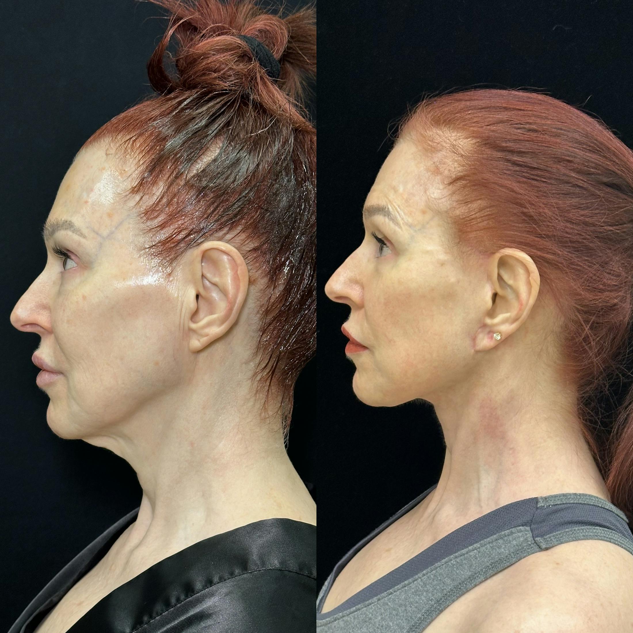 Deep Plane Facelift Before & After Gallery - Patient 268929 - Image 2