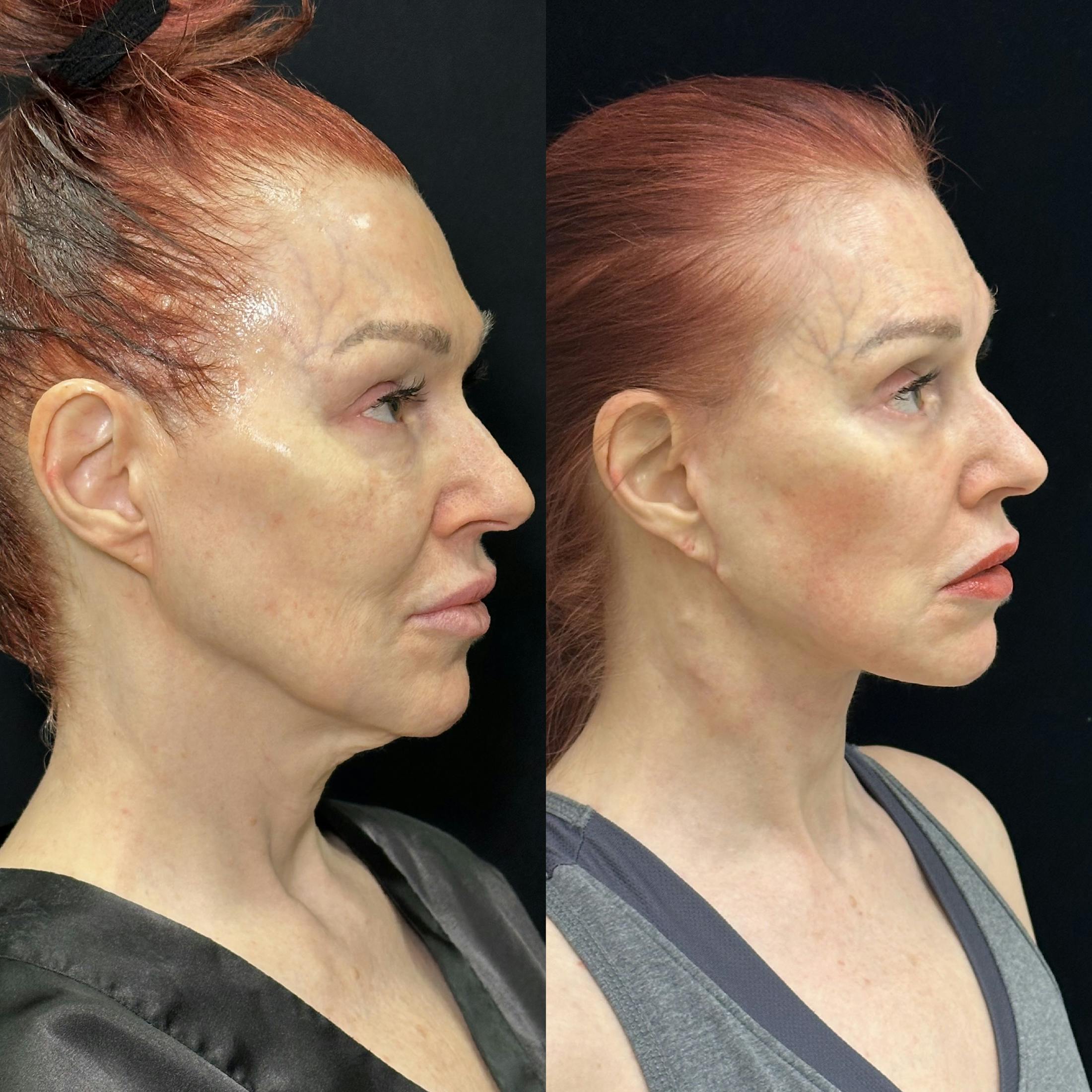 Deep Plane Facelift Before & After Gallery - Patient 268929 - Image 1