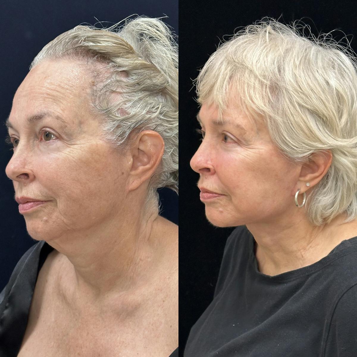 Deep Plane Facelift Before & After Gallery - Patient 186336 - Image 3
