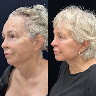 Deep Plane Facelift Before & After Gallery - Patient 186336 - Image 3