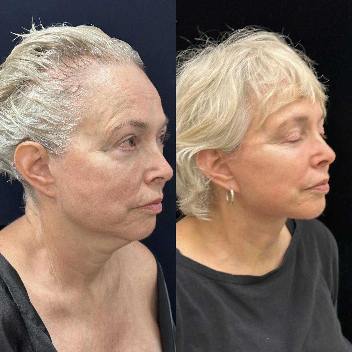 Deep Plane Facelift Before & After Gallery - Patient 186336 - Image 1