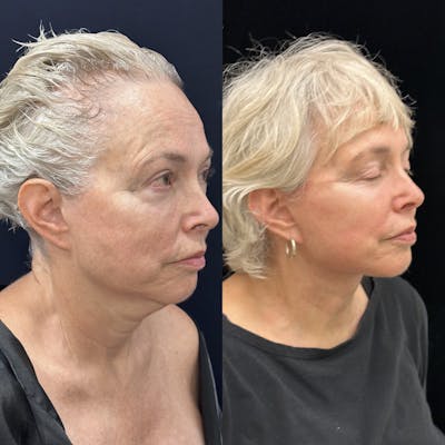 Deep Plane Facelift Before & After Gallery - Patient 186336 - Image 1