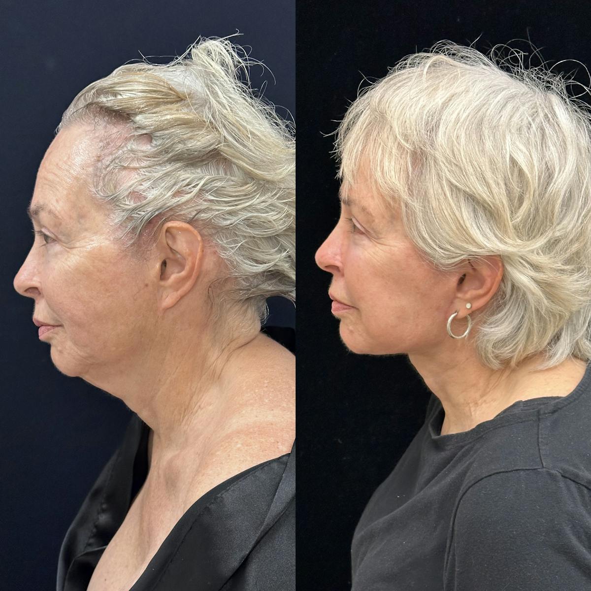 Deep Plane Facelift Before & After Gallery - Patient 186336 - Image 4
