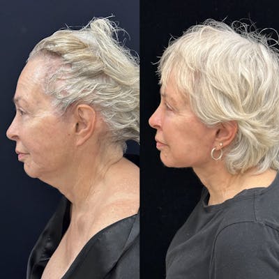 Deep Plane Facelift Before & After Gallery - Patient 186336 - Image 4