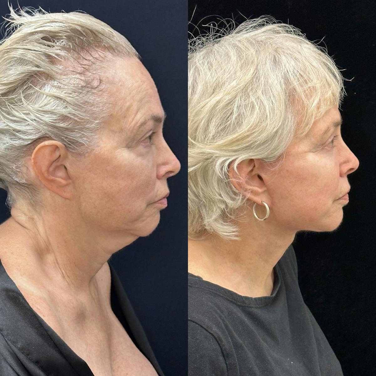 Deep Plane Facelift Before & After Gallery - Patient 186336 - Image 2