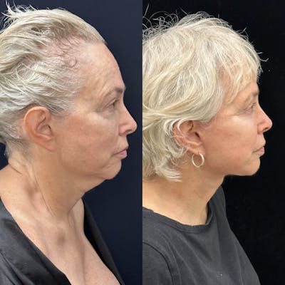 Deep Plane Facelift Before & After Gallery - Patient 186336 - Image 2