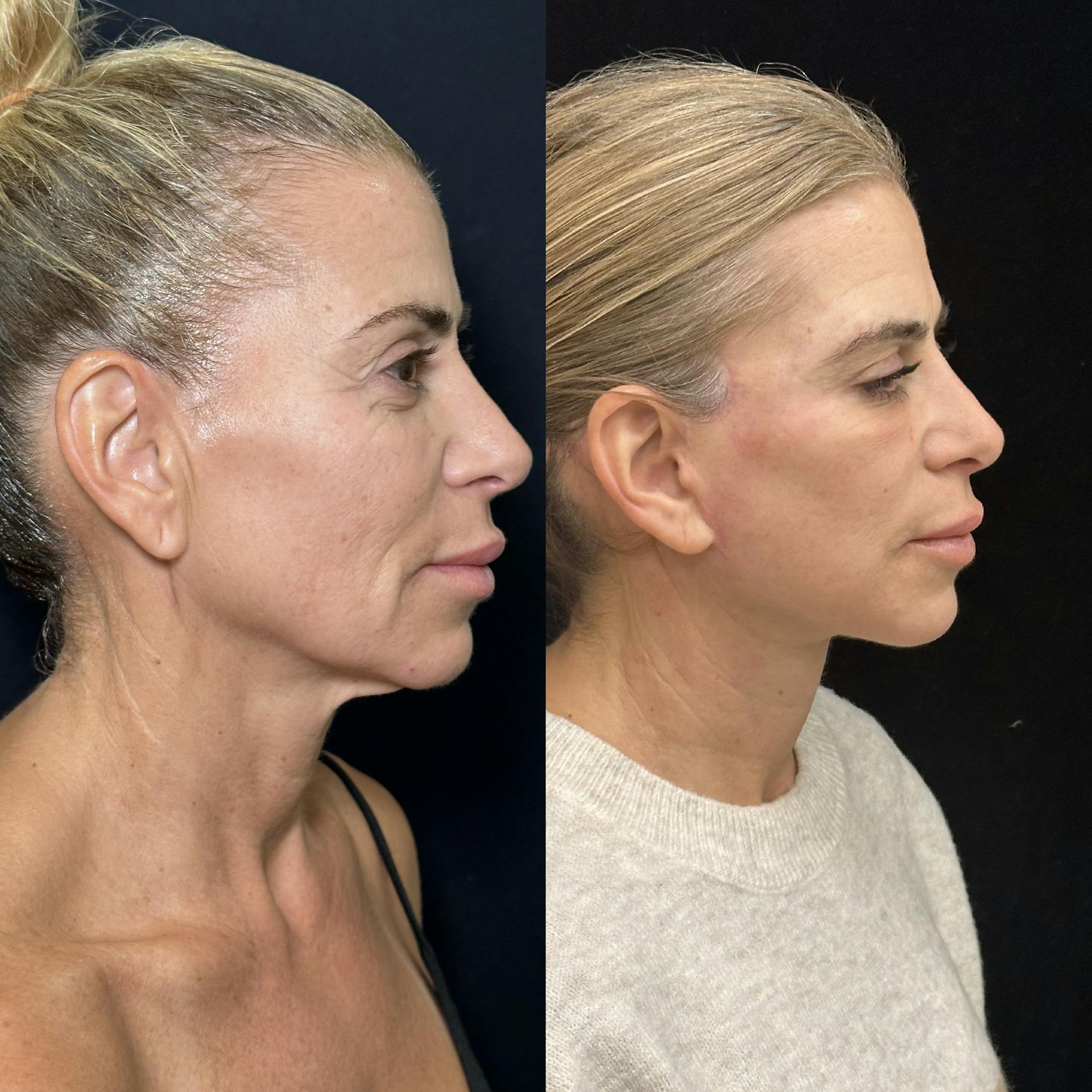 Deep Plane Facelift Before & After Gallery - Patient 274368 - Image 1